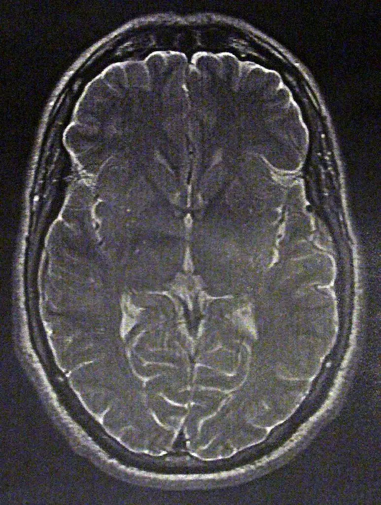 Transparency Sought In Mystery Brain Illness Investigation