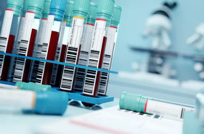 a-new-blood-test-detects-early-signs-of-cancer-without-symptoms