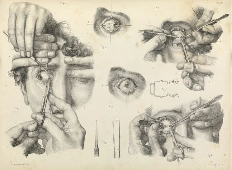 1800's Crossed Eye Correction Surgery