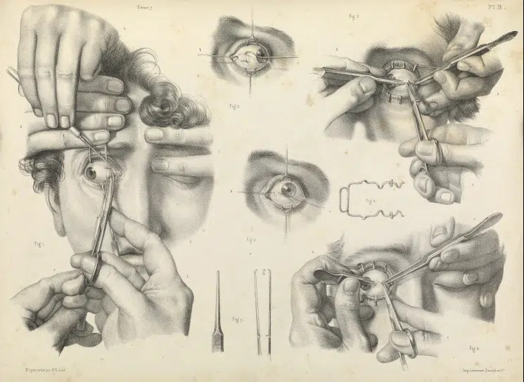 eye cross correction