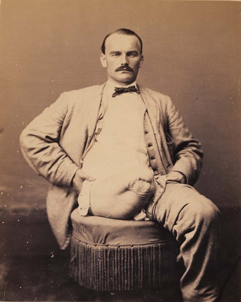 leg amputee civil war