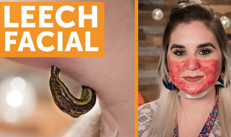 leech facial