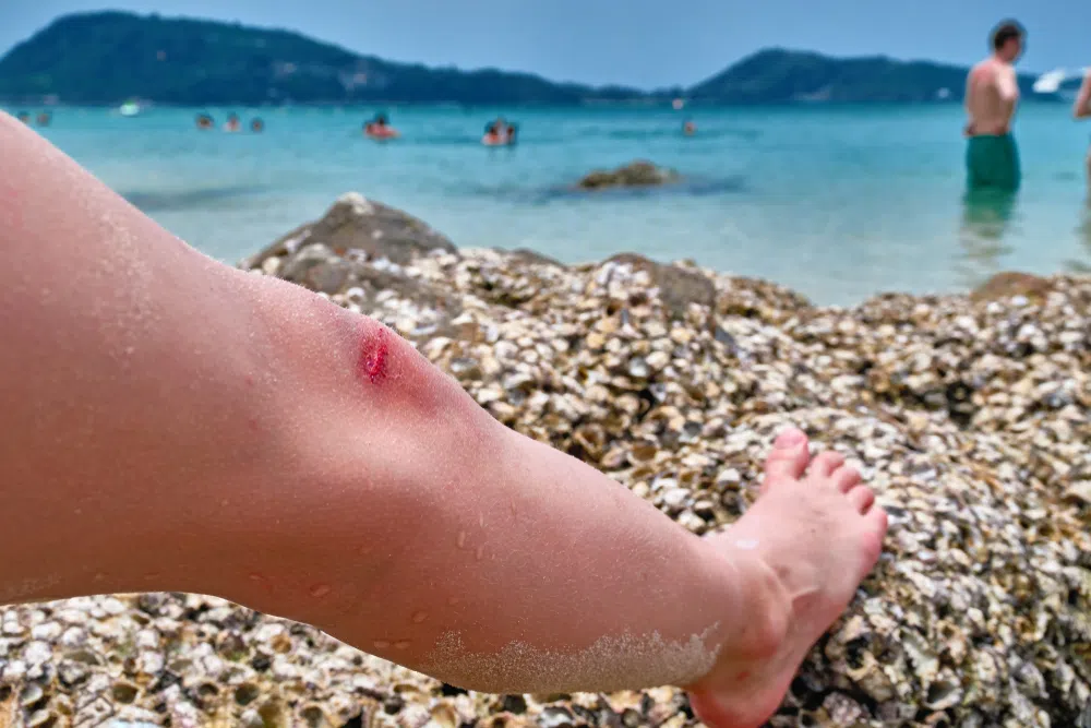 bleeding at the beach