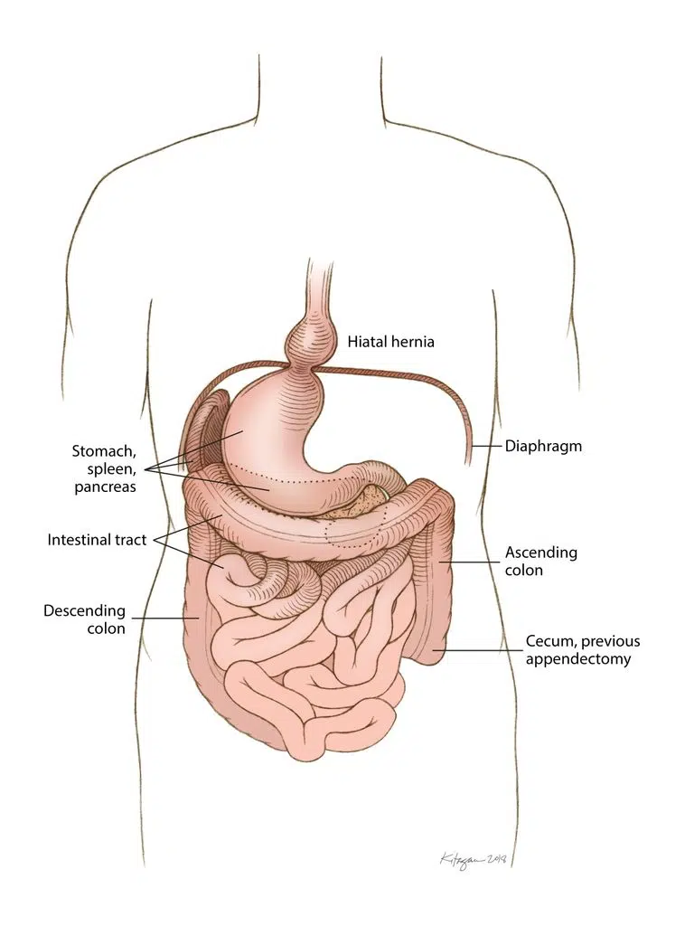 situs inversus