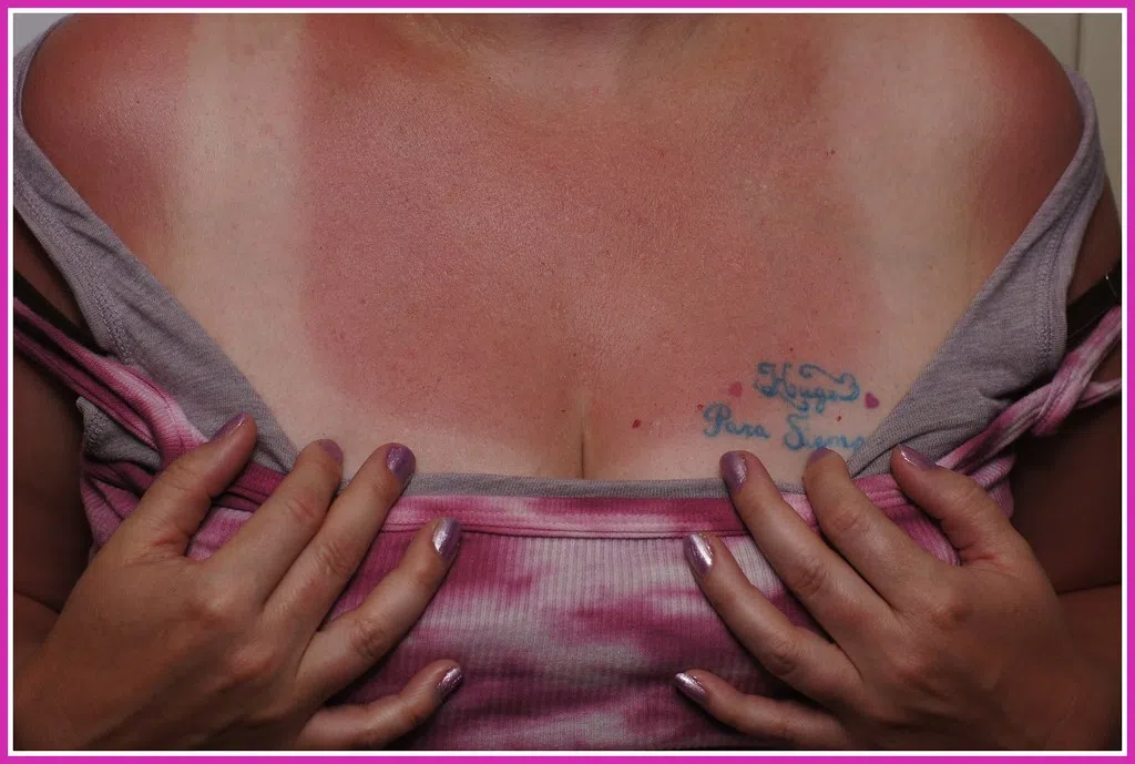 Right Now Is the Worst Time of Year for Sunburns