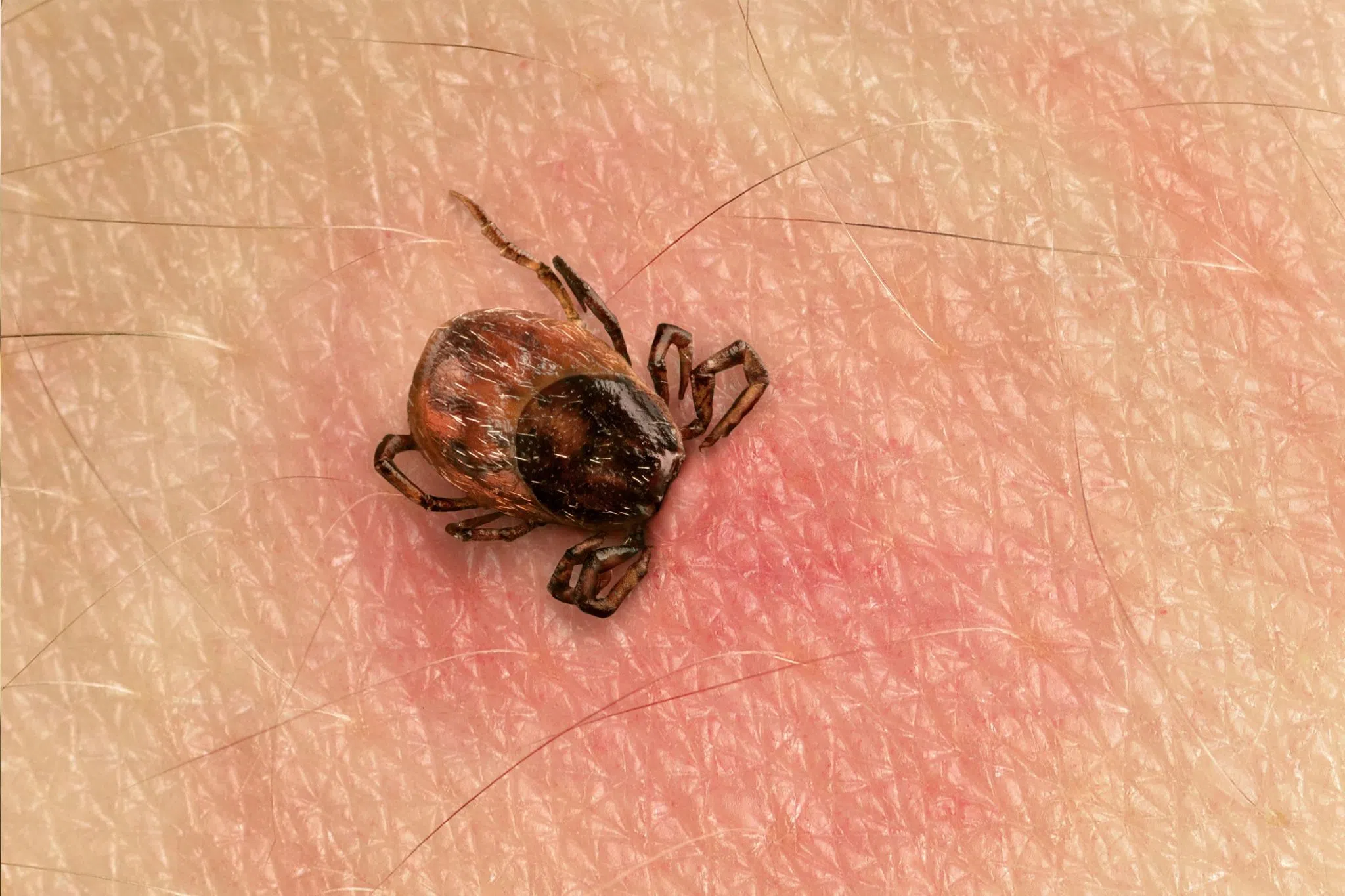 Grey Bruce Health Unit Offers Tips To Avoid Contracting Lyme Disease During Tick Season